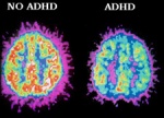 Brain Imaging of the ADHD Brain